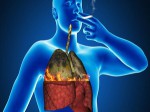 Những dấu hiệu sớm của bệnh ung thư phổi ở nam giới