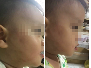 Hà Nội: Phụ huynh “tố” bé 20 tháng bị cô giáo đánh bầm tím ở lớp