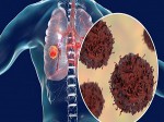Các tác nhân gây ung thư phổi, căn bệnh “sát thủ” hàng đầu ở nam giới