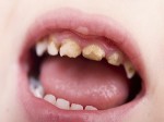 7 thói quen gây hại cho răng ai cũng nên biết