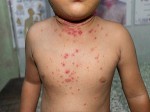 Việt Nam lên 3 kịch bản ứng phó với bệnh đậu mùa khỉ