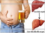 Dấu hiệu bất thường ở bụng cho thấy gan đang 'kêu cứu' vì quá tải rượu bia